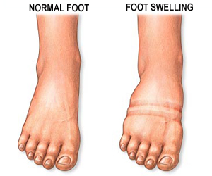 diabetes symptoms feet swelling http pipernet com mx fotos diabetes ...