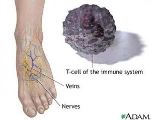 diabetic foot numbness