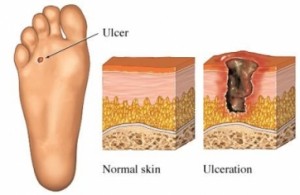 diabetic foot sore diabetic foot sore