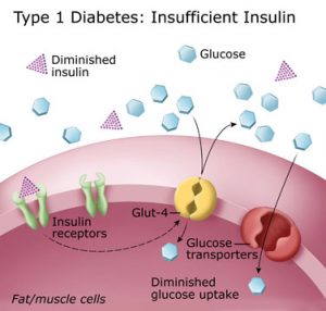 is type 1 diabetes hereditary