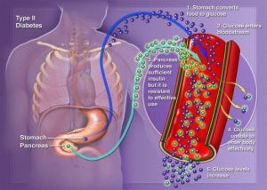 what is type ii diabetes what is type ii diabetes